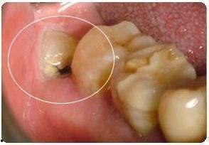 成人怎么把智齿拔掉视频,成人智齿拔除全攻略